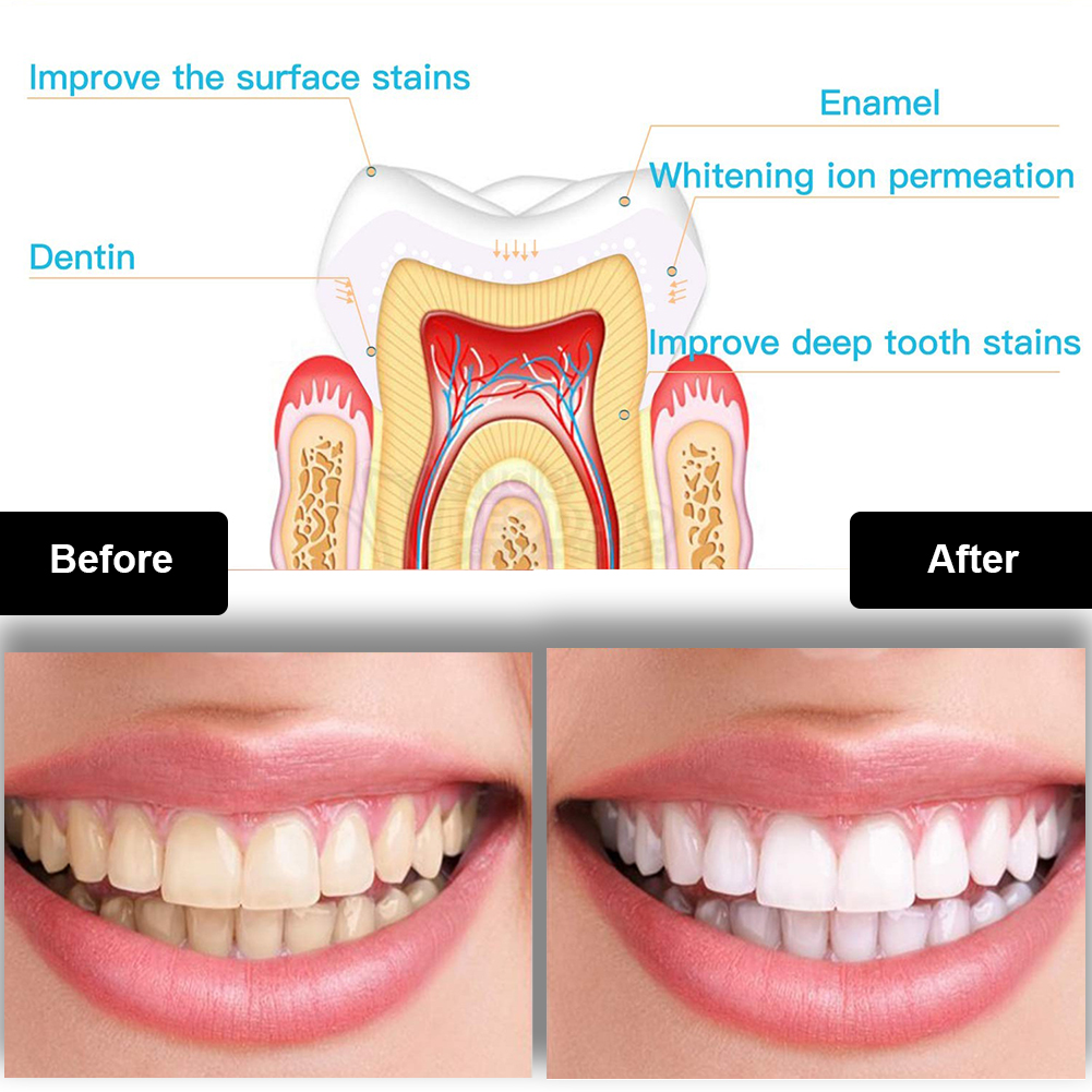 Dental Teeth Whitening Kit Min - Teeth Whitening Bleaching Kit review and price