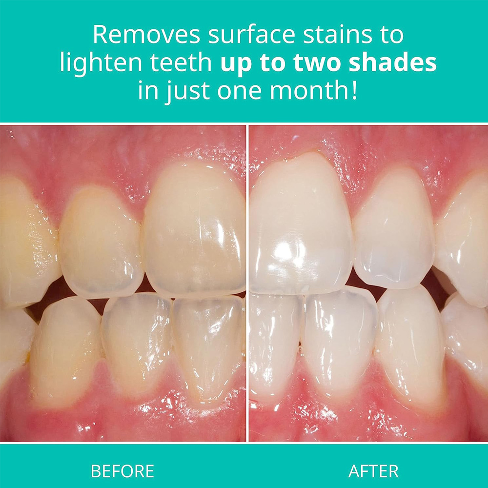 Opalescence Whitening Toothpas - Teeth Whitening Gel Opalescence review and price