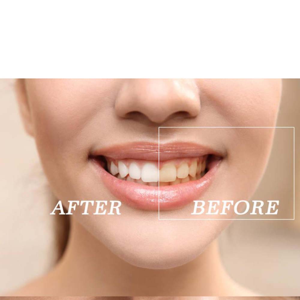 Top Quality Peroxide Teeth Whi - Teeth Whitening Bleaching Kit review and price