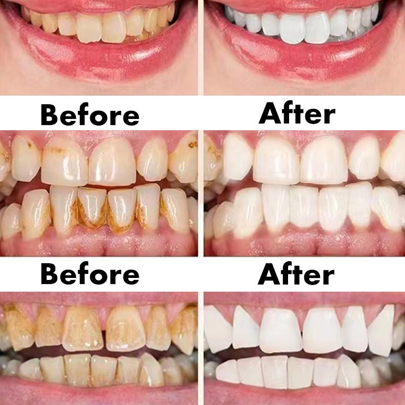 Teeth Whitening Pen Dental Ess - Teeth Whitening Bleaching Kit review and price