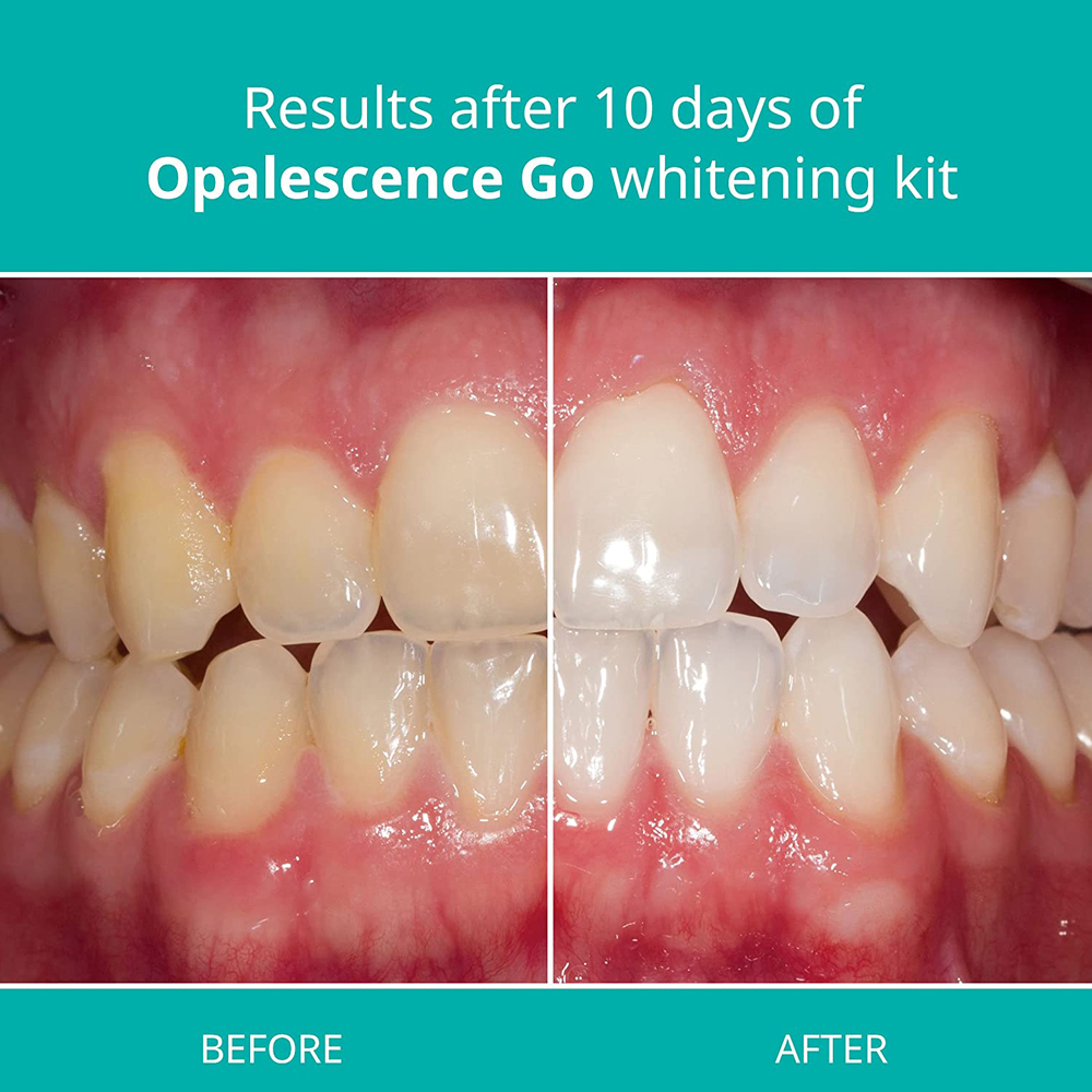 Opalescence Go Teeth Whitening - Teeth Whitening Gel Opalescence review and price